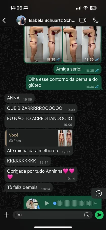 Depoimento da paciente Isabela Schuartz sobre radiofrequência