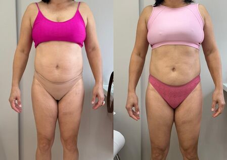 Resultado criolipólise frente - tratamento avançado redução gordura Dra. Anna Abreu