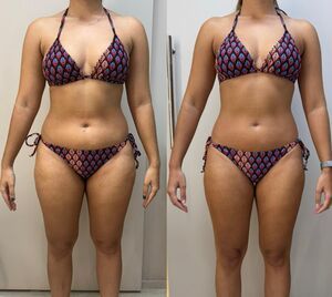 Resultado criolipólise depois frente - transformação corporal Dra. Anna Abreu