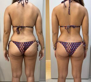 Resultado criolipólise depois trás - resultados visíveis Dra. Anna Abreu